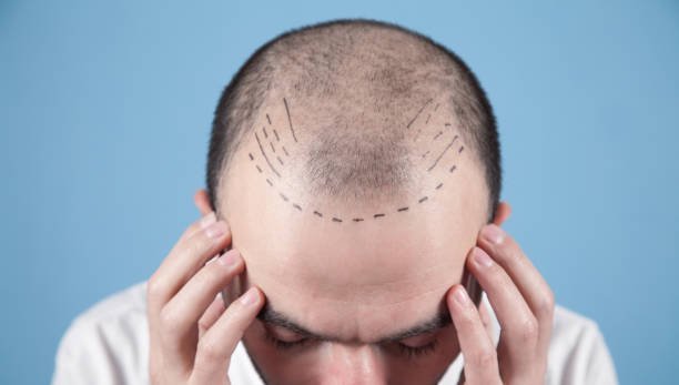 Hair transplant planning
